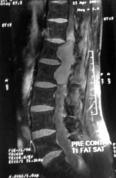 Functional Paraganglioma: A Rare Conus-cauda Lesion.