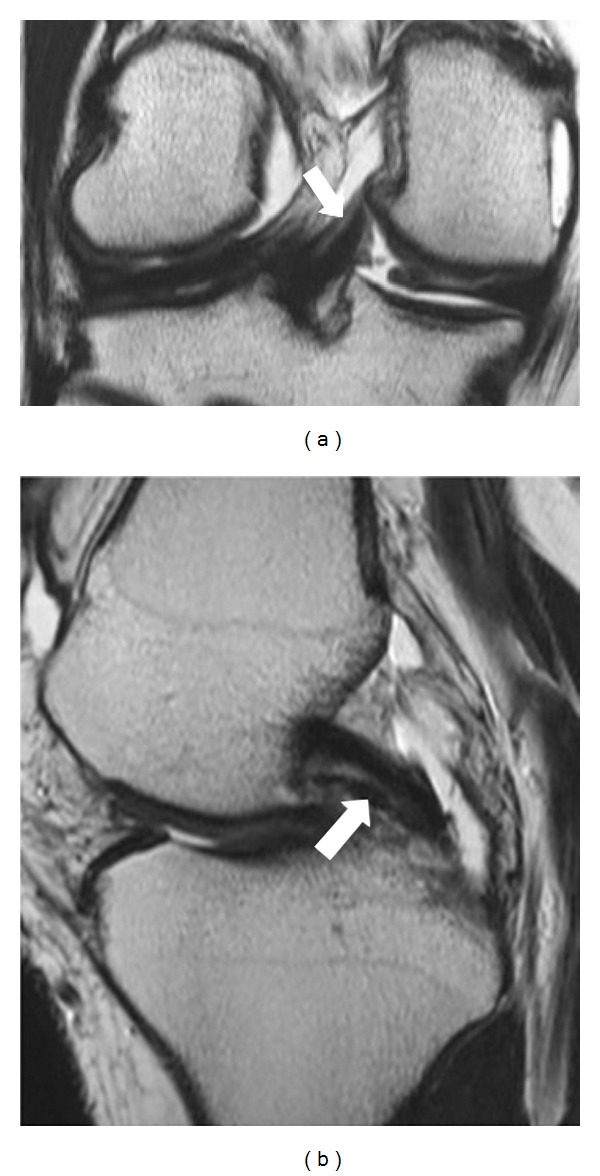 Anterior and posterior meniscofemoral ligaments: MRI evaluation.