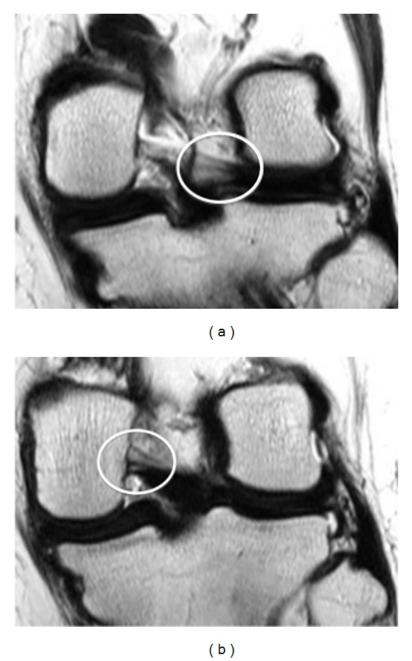 Anterior and posterior meniscofemoral ligaments: MRI evaluation.