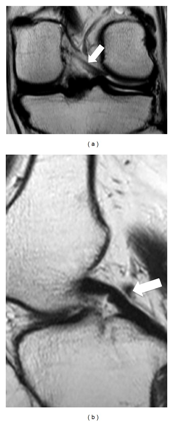 Anterior and posterior meniscofemoral ligaments: MRI evaluation.
