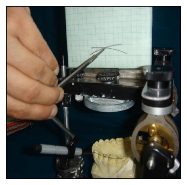 Occlusal plane determination using custom made broadrick occlusal plane analyser: a case control study.