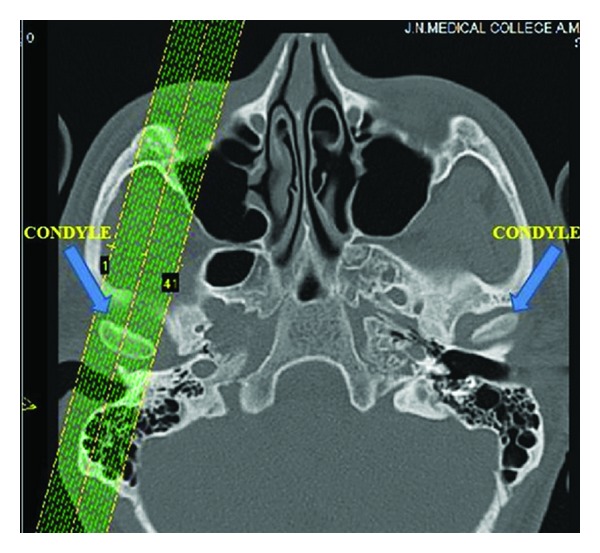 Computed Tomography Evaluation of Craniomandibular Articulation in Class II Division 1 Malocclusion and Class I Normal Occlusion Subjects in North Indian Population.