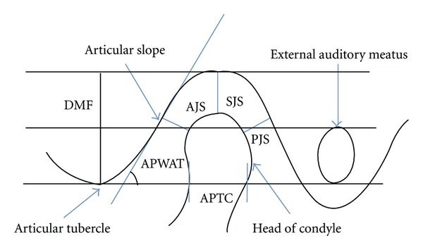 Computed Tomography Evaluation of Craniomandibular Articulation in Class II Division 1 Malocclusion and Class I Normal Occlusion Subjects in North Indian Population.