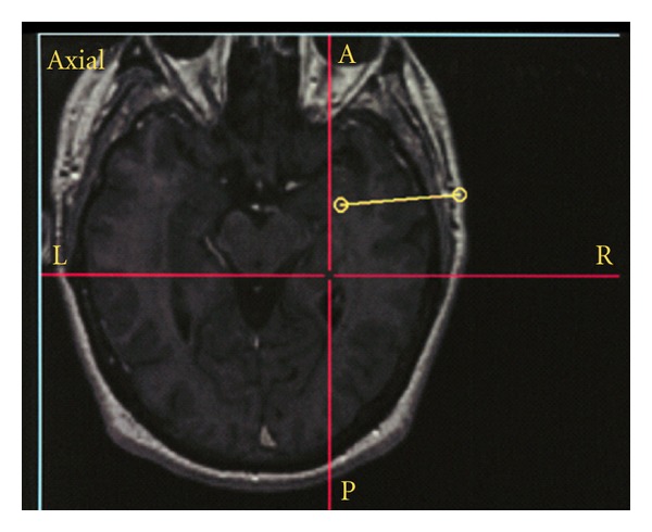 Selective amygdalohippocampectomy.