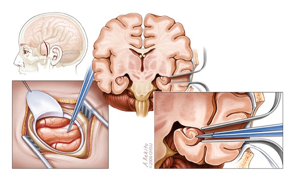 Selective amygdalohippocampectomy.