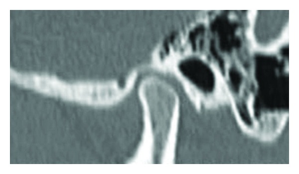 Computed Tomography Evaluation of Craniomandibular Articulation in Class II Division 1 Malocclusion and Class I Normal Occlusion Subjects in North Indian Population.