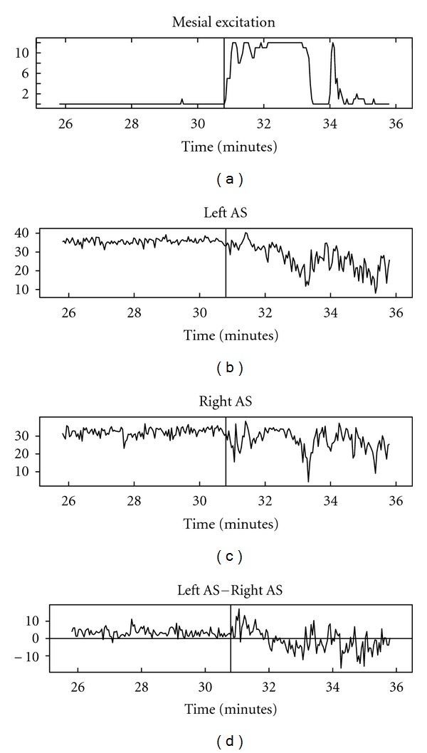 Extrahippocampal desynchronization in nonlesional temporal lobe epilepsy.