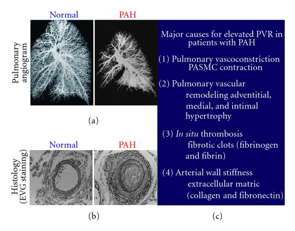 Pathogenic role of store-operated and receptor-operated ca(2+) channels in pulmonary arterial hypertension.