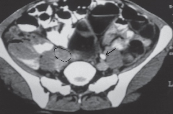 Ureteric obstruction: A unique case.
