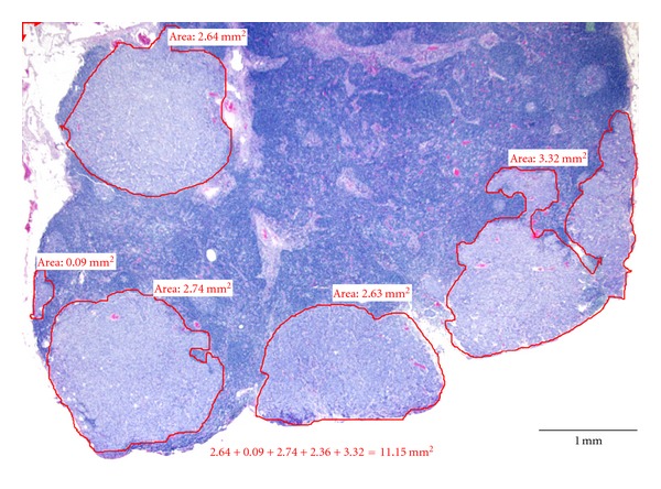 The prognostic value of lymph node cross-sectional cancer area in node-positive breast cancer: a comparison with N stage and lymph node ratio.