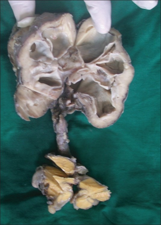 Ureteric obstruction: A unique case.