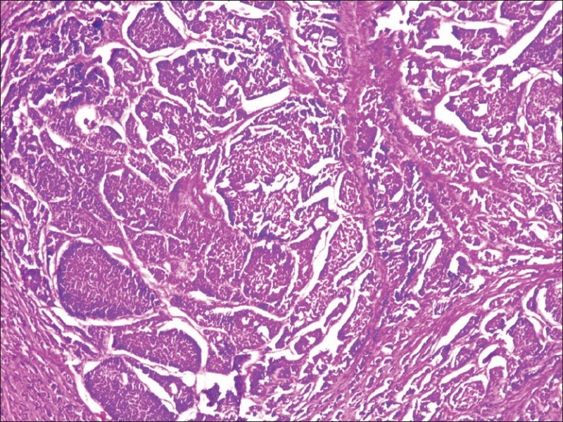 Ureteric obstruction: A unique case.