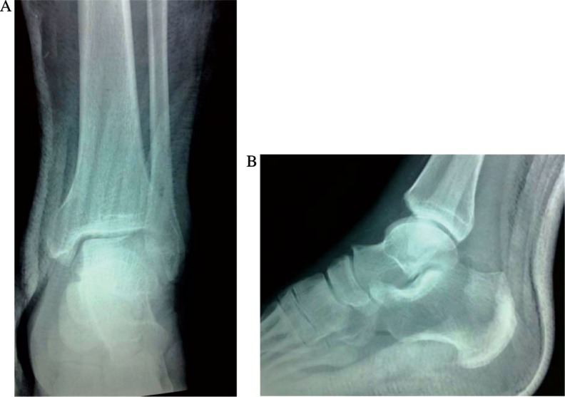 Conservative treatment of an anterior-lateral ankle dislocation without an associated fracture in a diabetic patient: a case report.