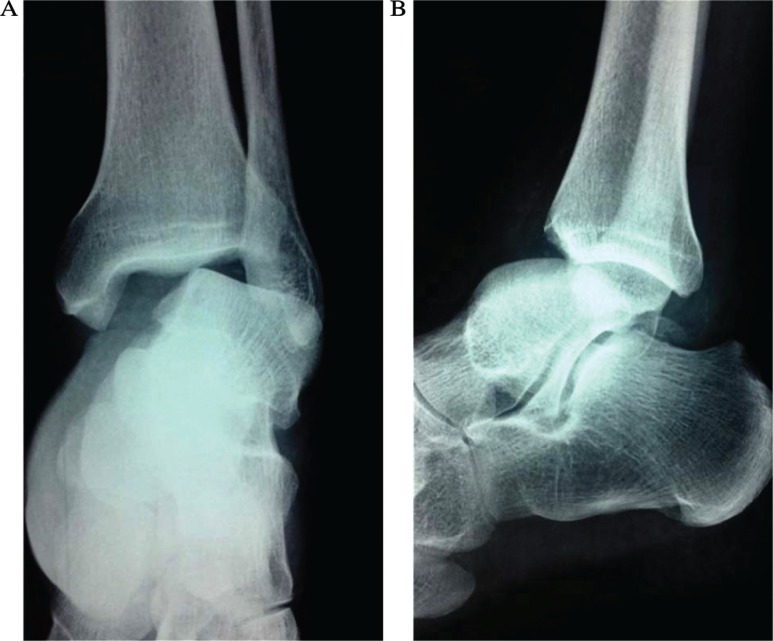 Conservative treatment of an anterior-lateral ankle dislocation without an associated fracture in a diabetic patient: a case report.