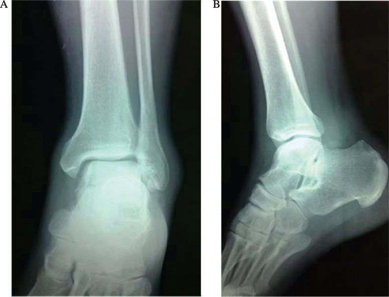 Conservative treatment of an anterior-lateral ankle dislocation without an associated fracture in a diabetic patient: a case report.