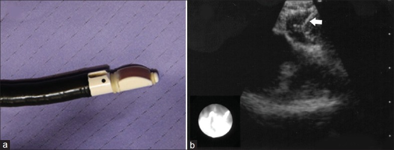 Advances in bronchoscopy for lung cancer.