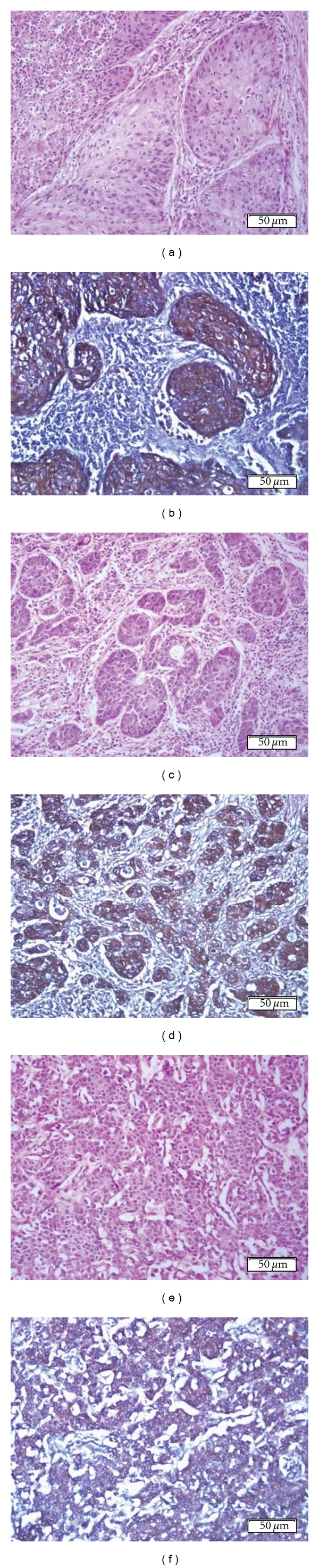 Immunoreactivity of the 14F7 Mab (Raised against N-Glycolyl GM3 Ganglioside) as a Positive Prognostic Factor in Non-Small-Cell Lung Cancer.