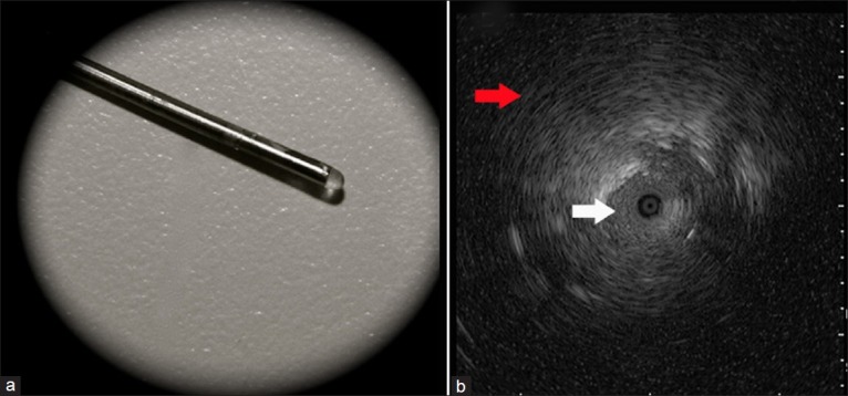 Advances in bronchoscopy for lung cancer.