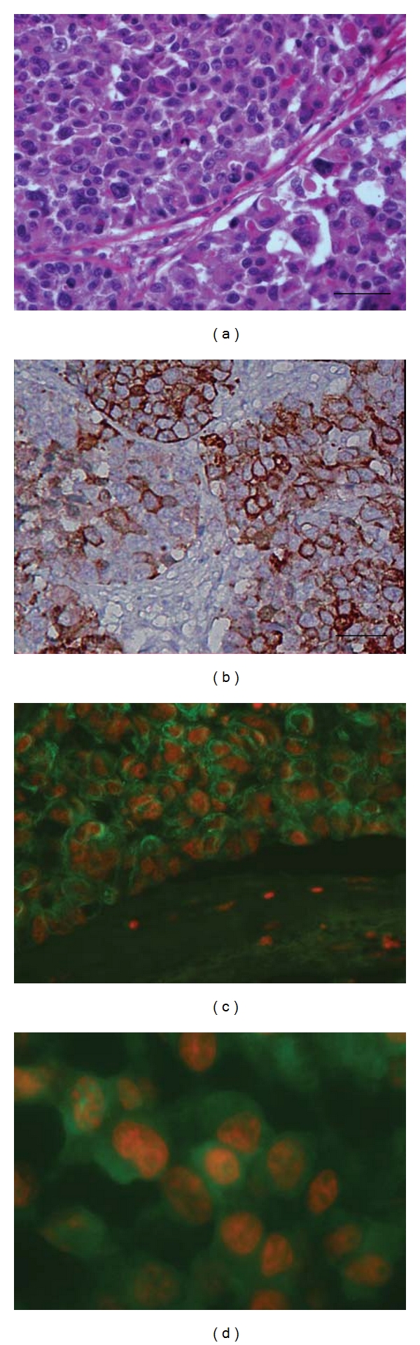 Immunoreactivity of the 14F7 Mab (Raised against N-Glycolyl GM3 Ganglioside) as a Positive Prognostic Factor in Non-Small-Cell Lung Cancer.