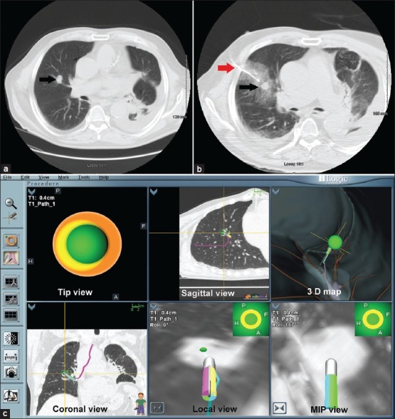 Advances in bronchoscopy for lung cancer.