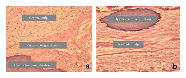 Histopathological features of dental pulp in teeth with different levels of chronic periodontitis severity.