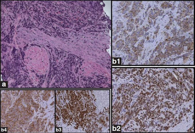 Pure small cell carcinoma of the prostate: A rare tumor.