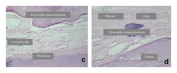 Histopathological features of dental pulp in teeth with different levels of chronic periodontitis severity.