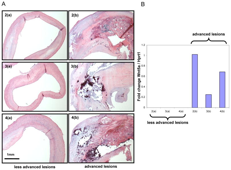 Increased Wnt5a mRNA Expression in Advanced Atherosclerotic Lesions, and Oxidized LDL Treated Human Monocyte-Derived Macrophages.