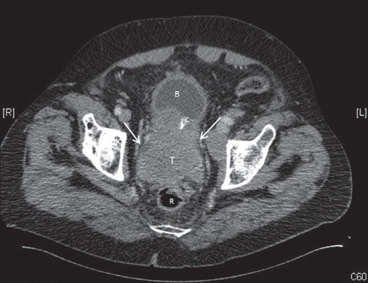 Pure small cell carcinoma of the prostate: A rare tumor.