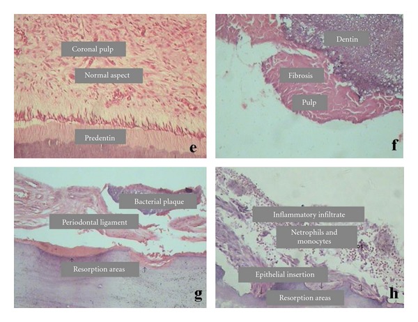 Histopathological features of dental pulp in teeth with different levels of chronic periodontitis severity.