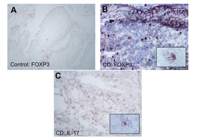 In Crohn's Disease, Anti-TNF-α Treatment Changes the Balance between Mucosal IL-17, FOXP3, and CD4 Cells.