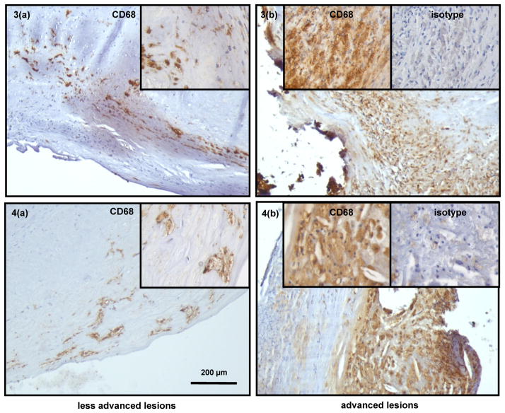 Increased Wnt5a mRNA Expression in Advanced Atherosclerotic Lesions, and Oxidized LDL Treated Human Monocyte-Derived Macrophages.