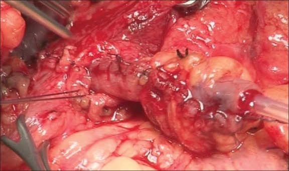 Radical urethrectomy with bladder preservation and continent catheterizable stoma (Yang-Monti tecnique).