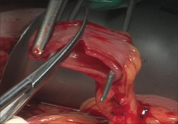 Radical urethrectomy with bladder preservation and continent catheterizable stoma (Yang-Monti tecnique).