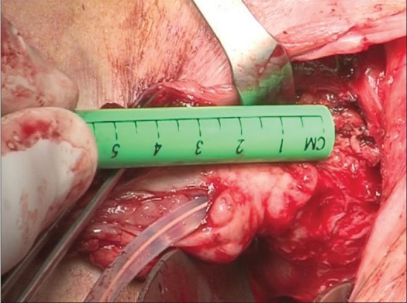 Radical urethrectomy with bladder preservation and continent catheterizable stoma (Yang-Monti tecnique).