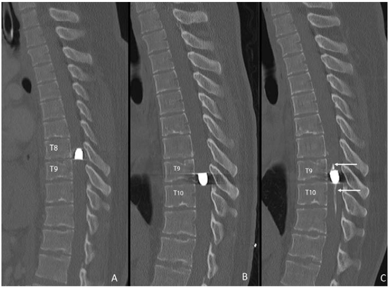 "The flipping bullet" with associated intramedullary dystrophic calcification: an unusual cause for migratory myelopathy and radiculopathy.