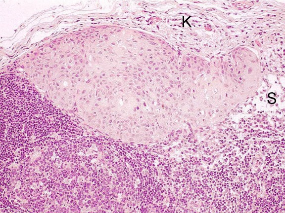Current advances in diagnosis and surgical treatment of lymph node metastasis in head and neck cancer.