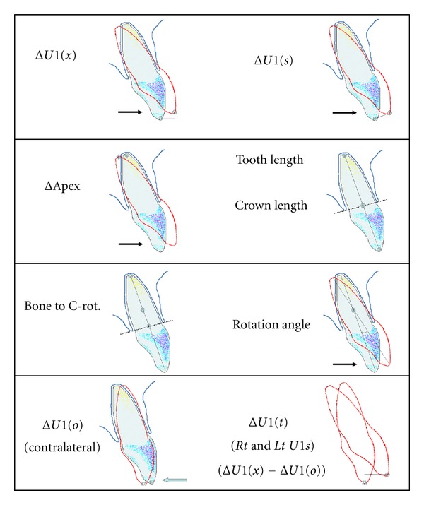 Orthodontic tooth movement with clear aligners.