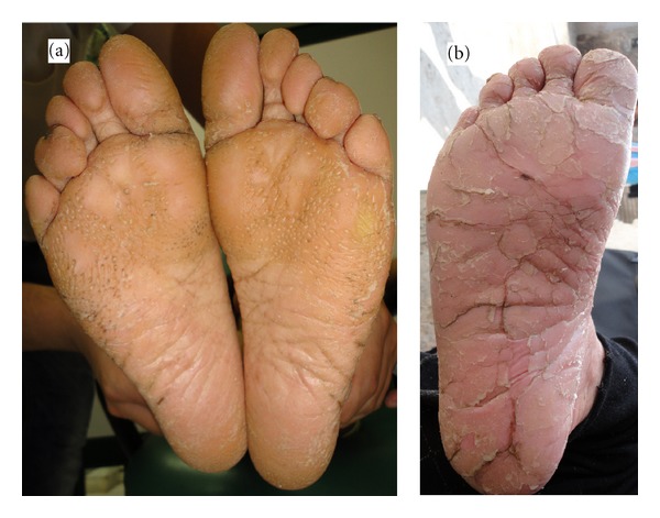 Papillon-lefèvre syndrome: a series of six cases in the same family.