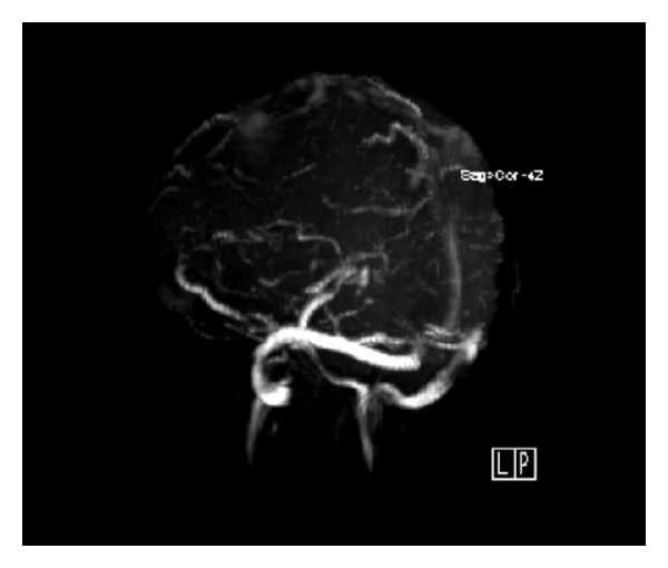 Behcet's Disease: New Concepts in Cardiovascular Involvements and Future Direction for Treatment.