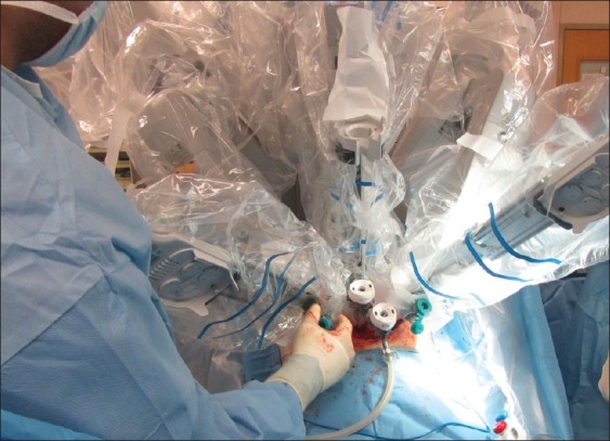 Robotic laparoendoscopic single-site surgery: From present to future.