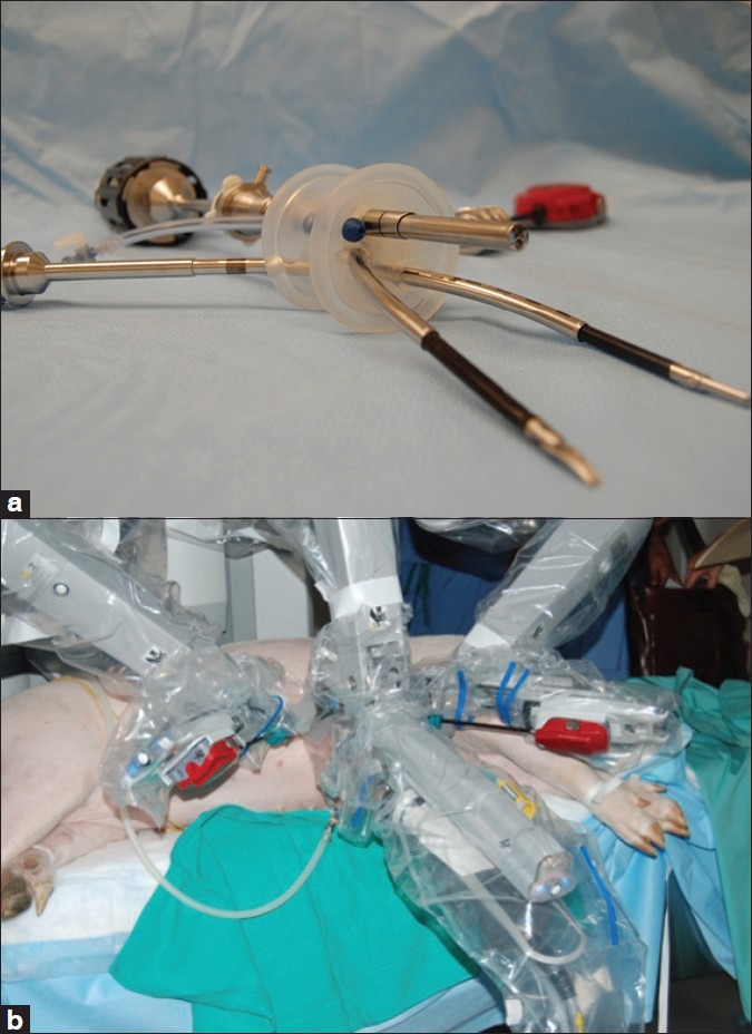 Robotic laparoendoscopic single-site surgery: From present to future.