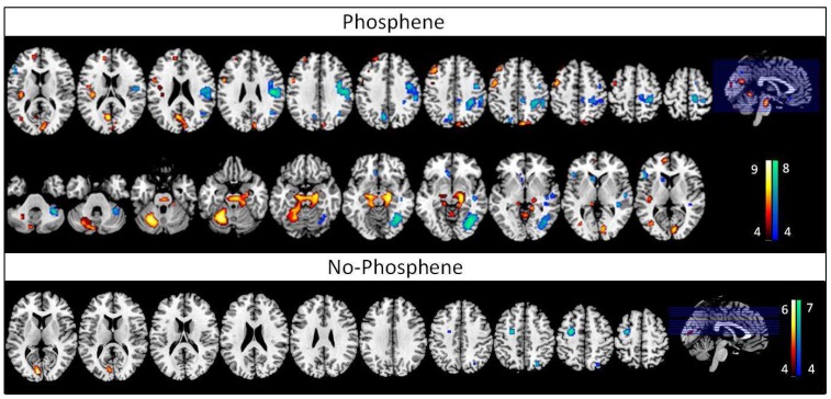 Is 1 Hz rTMS Always Inhibitory in Healthy Individuals?