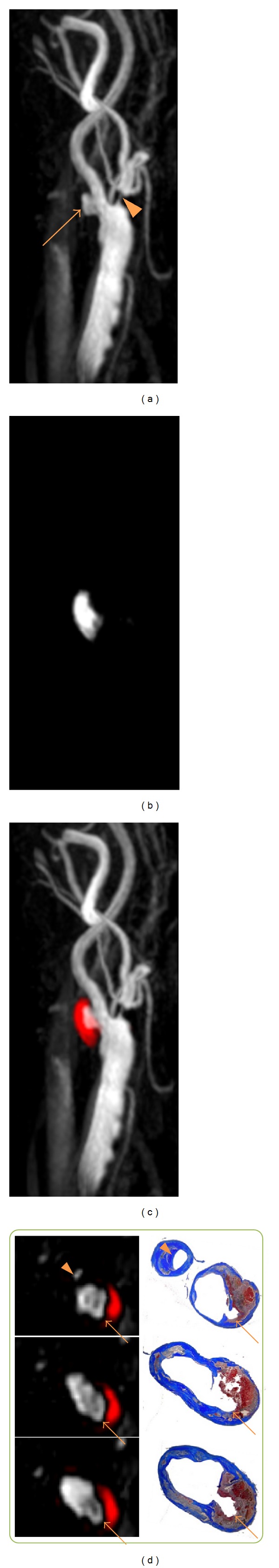 Carotid artery disease and stroke: assessing risk with vessel wall MRI.