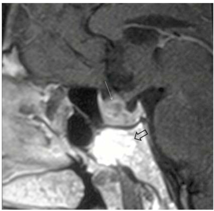 Sphenoclival intraosseous lipoma in skull base.