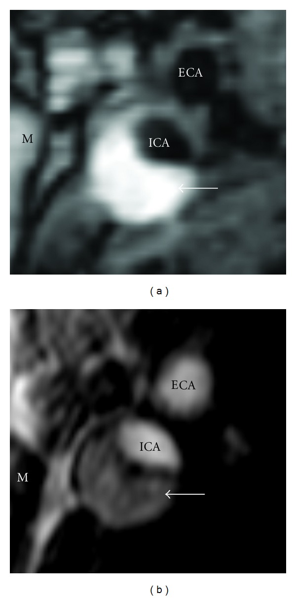 Carotid artery disease and stroke: assessing risk with vessel wall MRI.