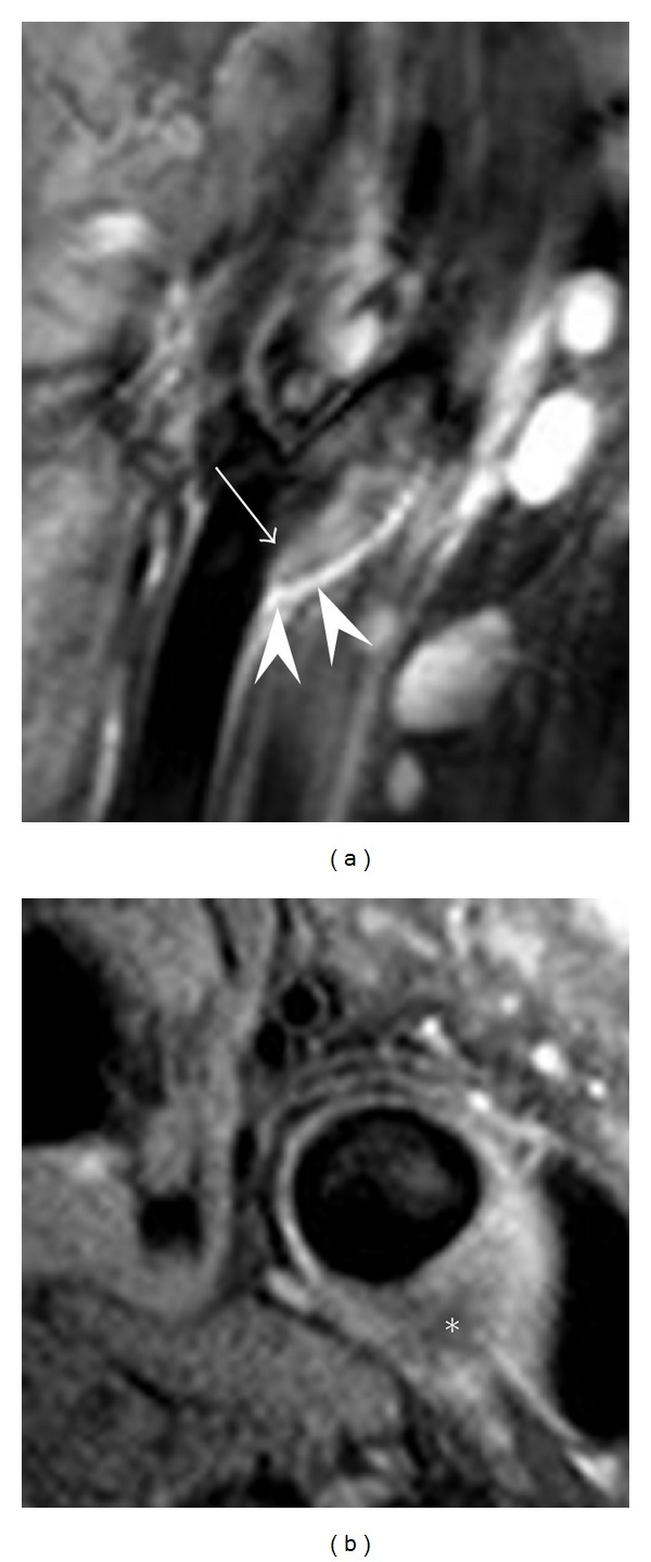 Carotid artery disease and stroke: assessing risk with vessel wall MRI.