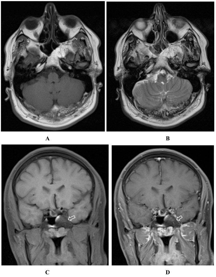 Sphenoclival intraosseous lipoma in skull base.