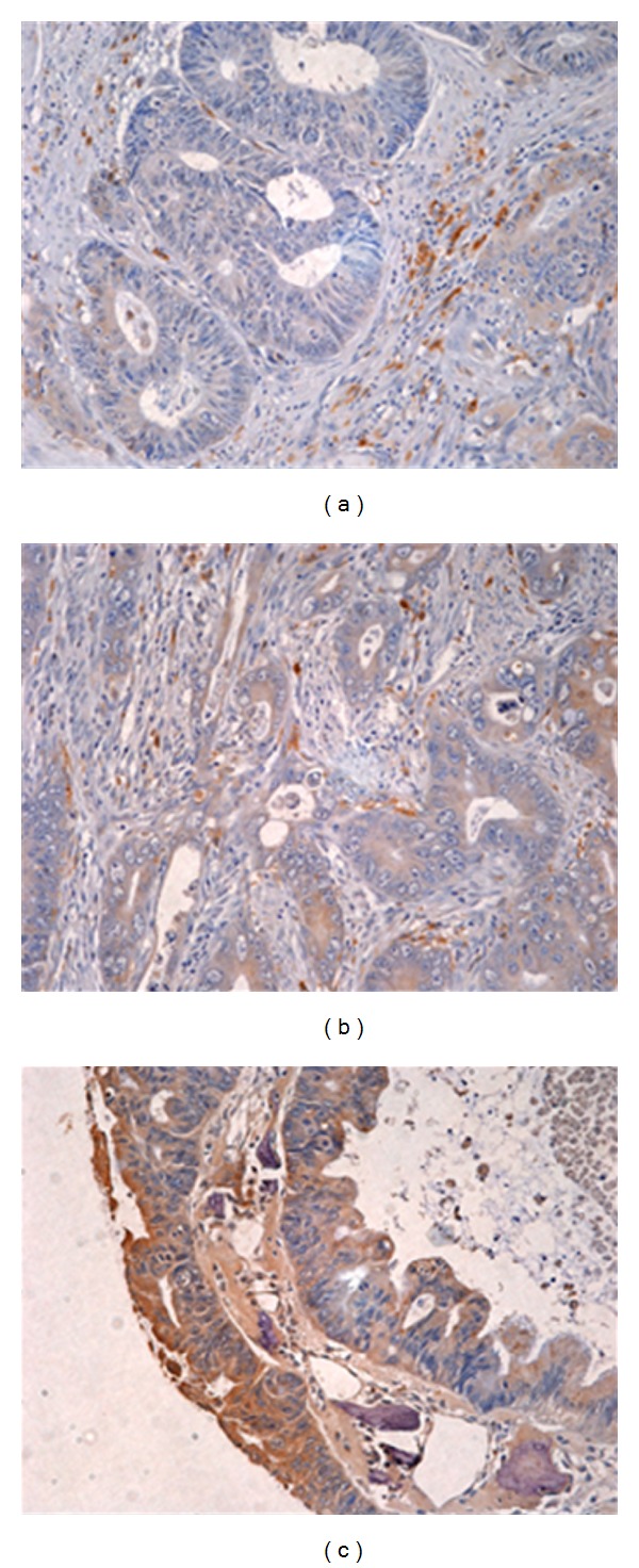 Cathepsin D Expression in Colorectal Cancer: From Proteomic Discovery through Validation Using Western Blotting, Immunohistochemistry, and Tissue Microarrays.