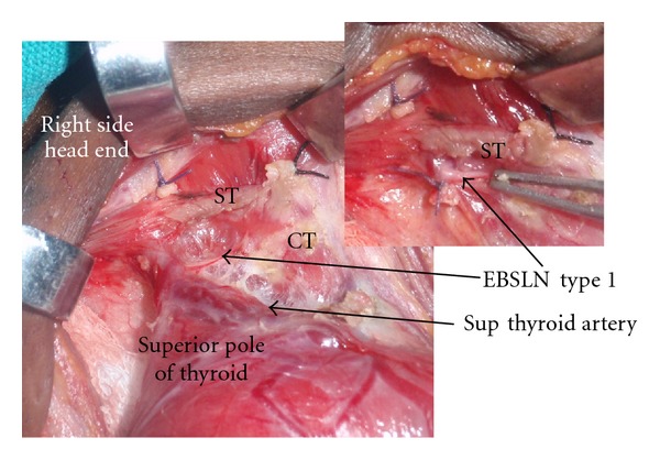A Closer Look at Laryngeal Nerves during Thyroid Surgery: A Descriptive Study of 584 Nerves.